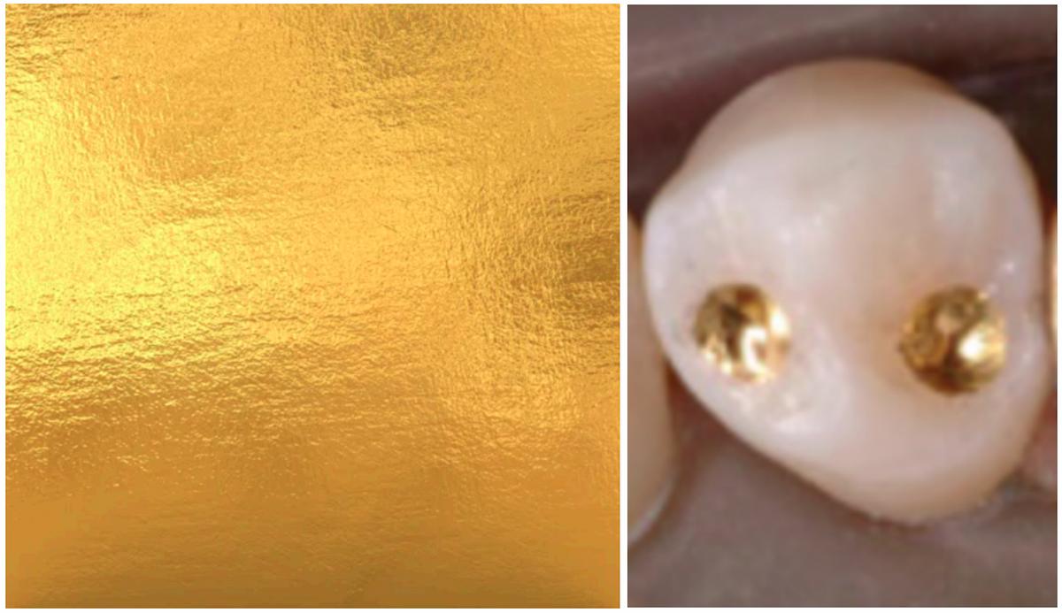 First lasting dental filling material - gold